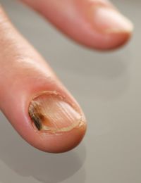 Nagelpilz erkennen und vorbeugen: So geht‘s | SAT.1 Ratgeber
